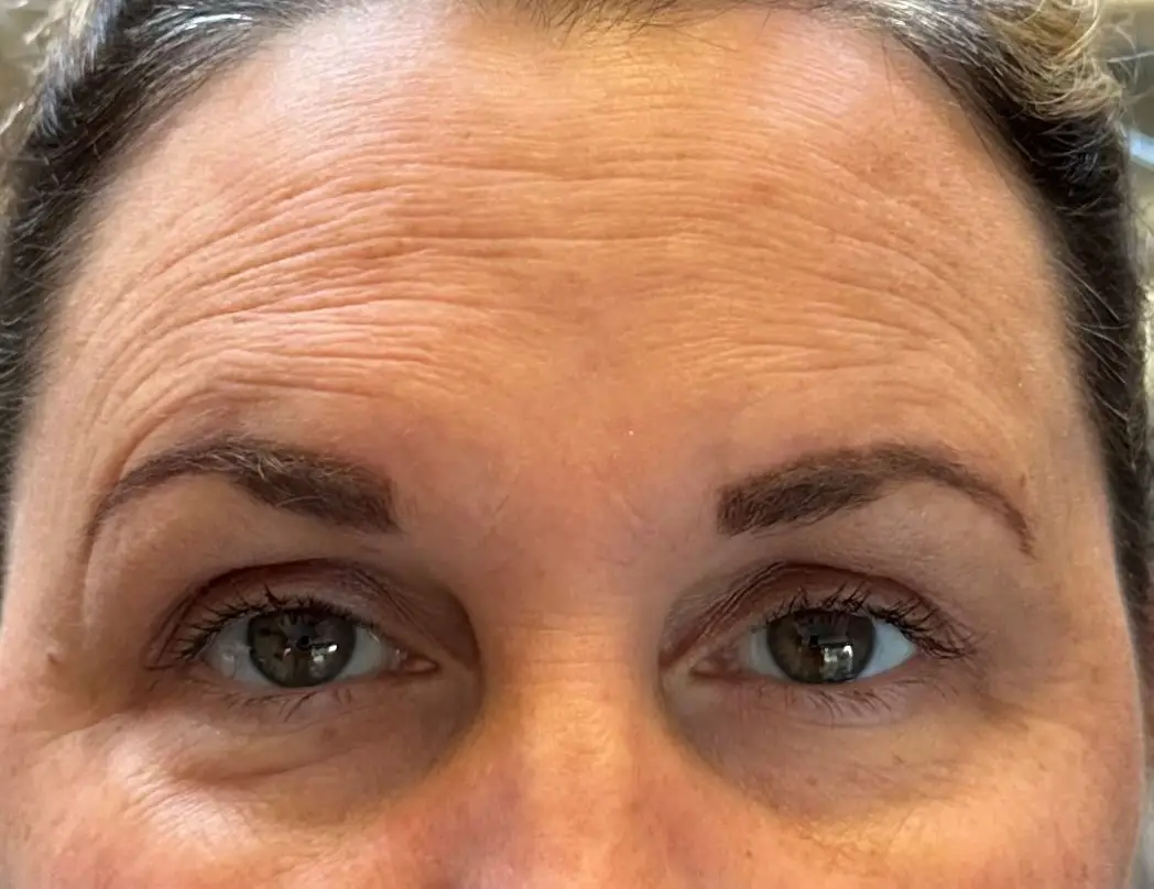 Botox Botox