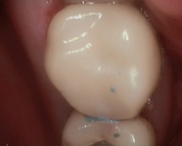 CEREC CEREC