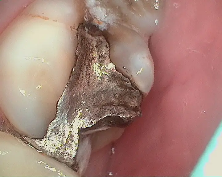 CEREC CEREC
