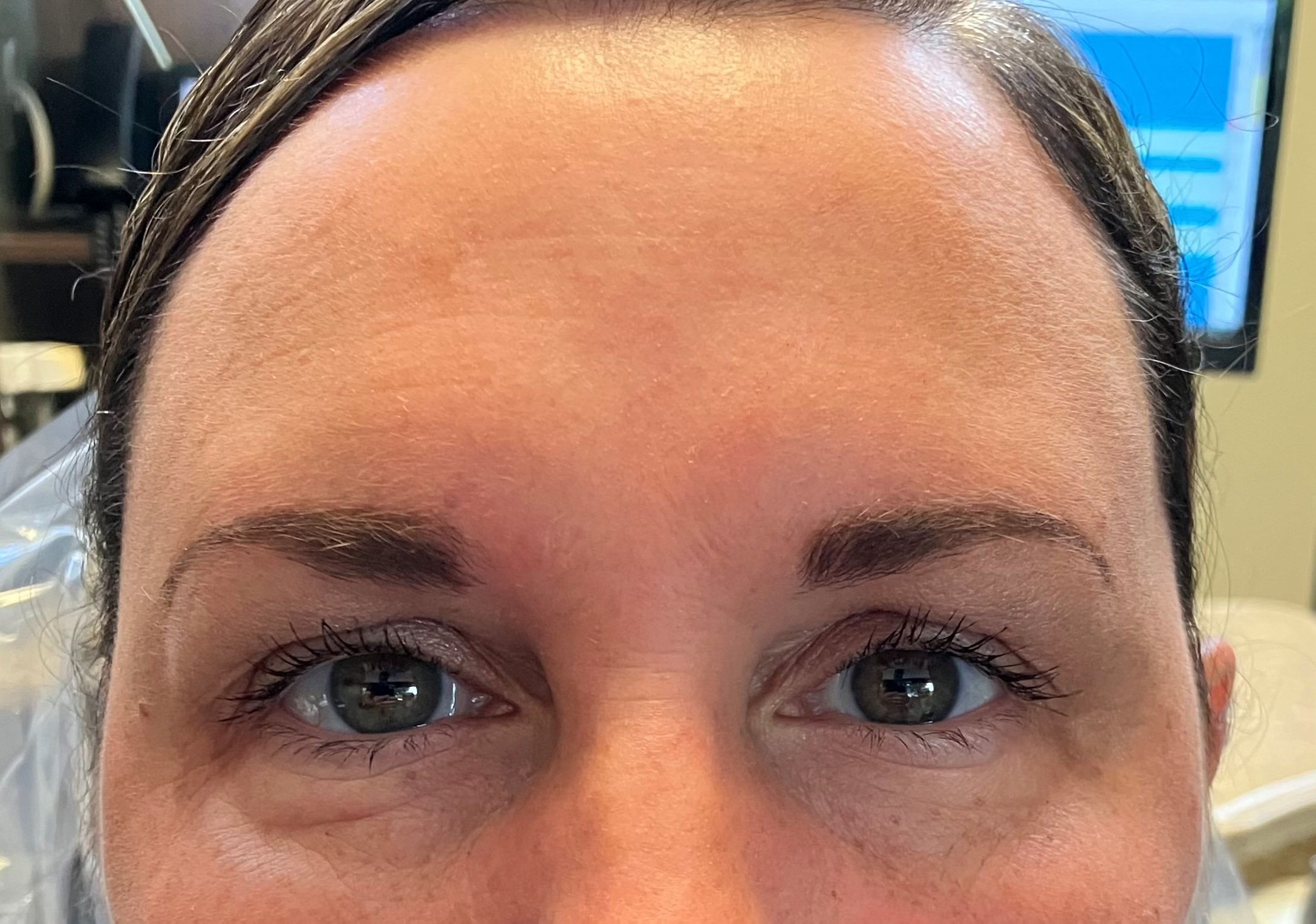 Botox Botox