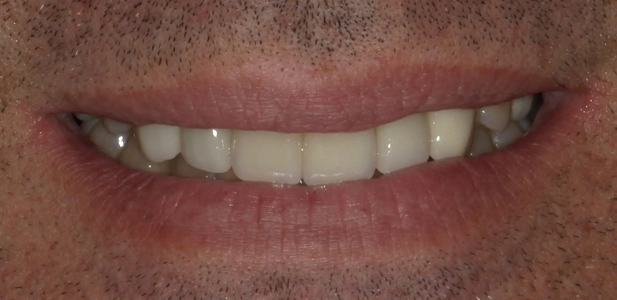 Smile Makeover Smile Makeover