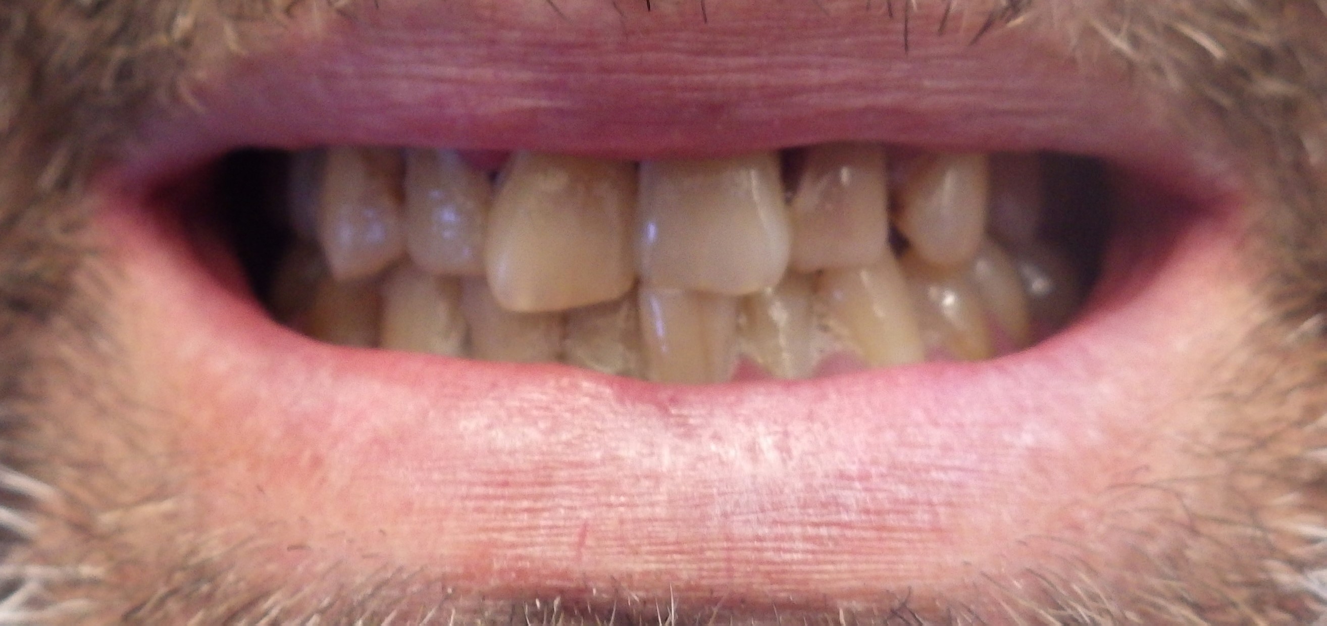 Smile Makeover Smile Makeover
