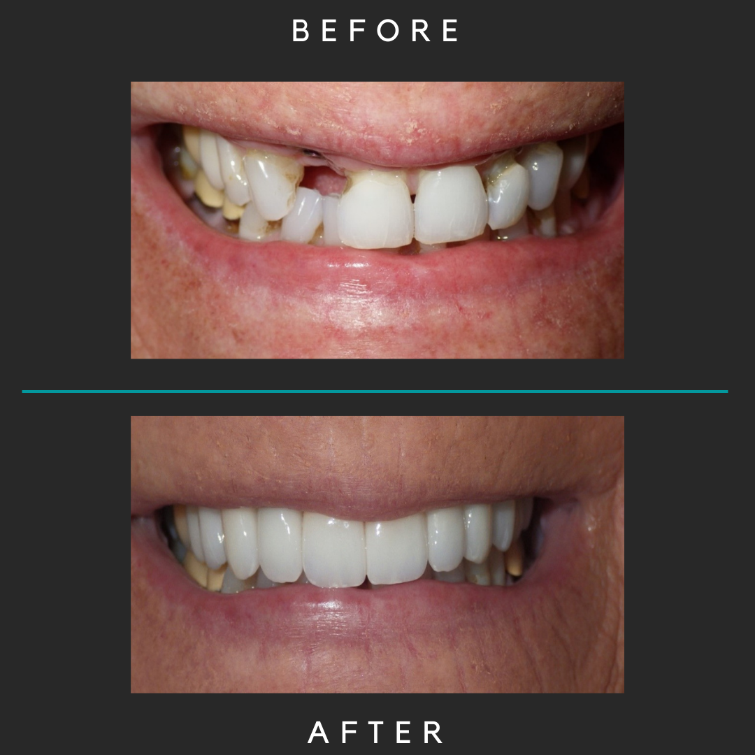 Before and After Smile Before and After Smile