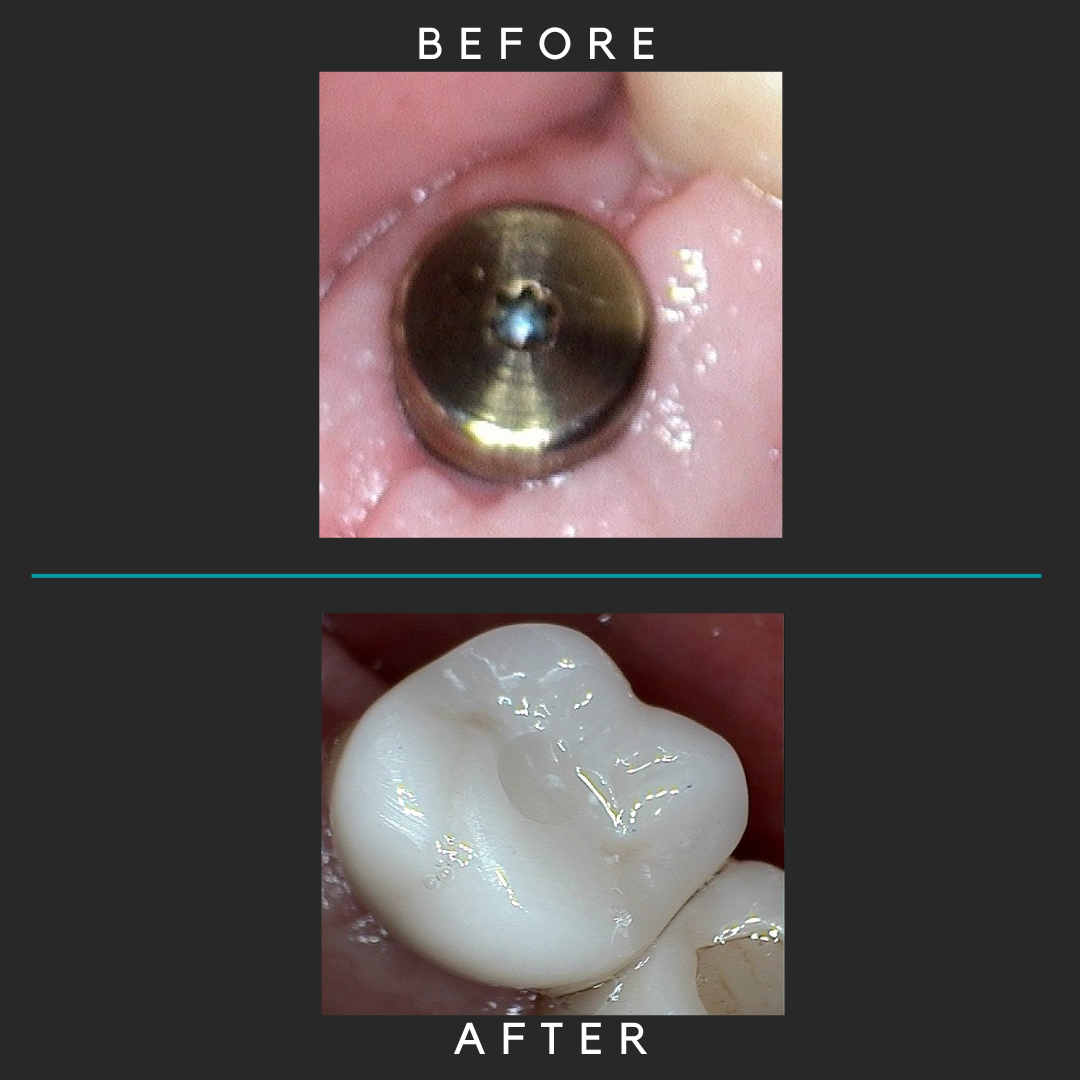 Dental Implants Before and After Dental Implants Before and After