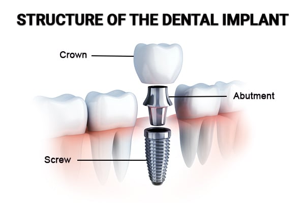 Dental Implants Dental Implants
